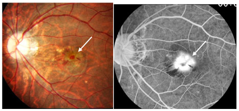 【図3】強度近視の黄斑部出血（矢印は新生血管を示す） 左：眼底写真、右：蛍光眼底造影写真