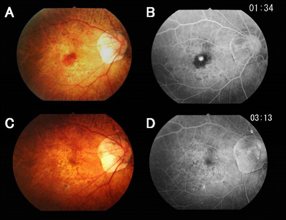 【図4】抗VEGF療法により治癒した新生血管を伴う黄斑部出血の症例 ［A・B］治療前。黄斑部に出血を伴う新生血管がみられる。［C・D］治療2年後。新生血管は完全に消失した。 視力は0.6から1.2に改善。