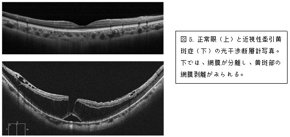 【図5】正常眼（上）と近視性牽引黄斑症（下）の光干渉断層計写真。下では、網膜が分離し、黄斑部の網膜剥離がみられる。