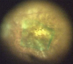 【図7】中心窩周囲内境界膜剥離術の術中写真　中心の周囲にのみ、残した内境界膜が緑色にみえている